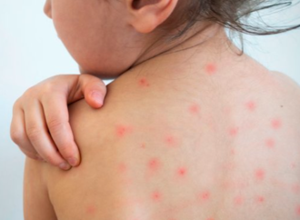 MINSAL CONFIRMA 11 CASOS DE SARAMPIÓN Y ACTIVA CERCO EPIDEMIOLÓGICO EN EL SALVADOR